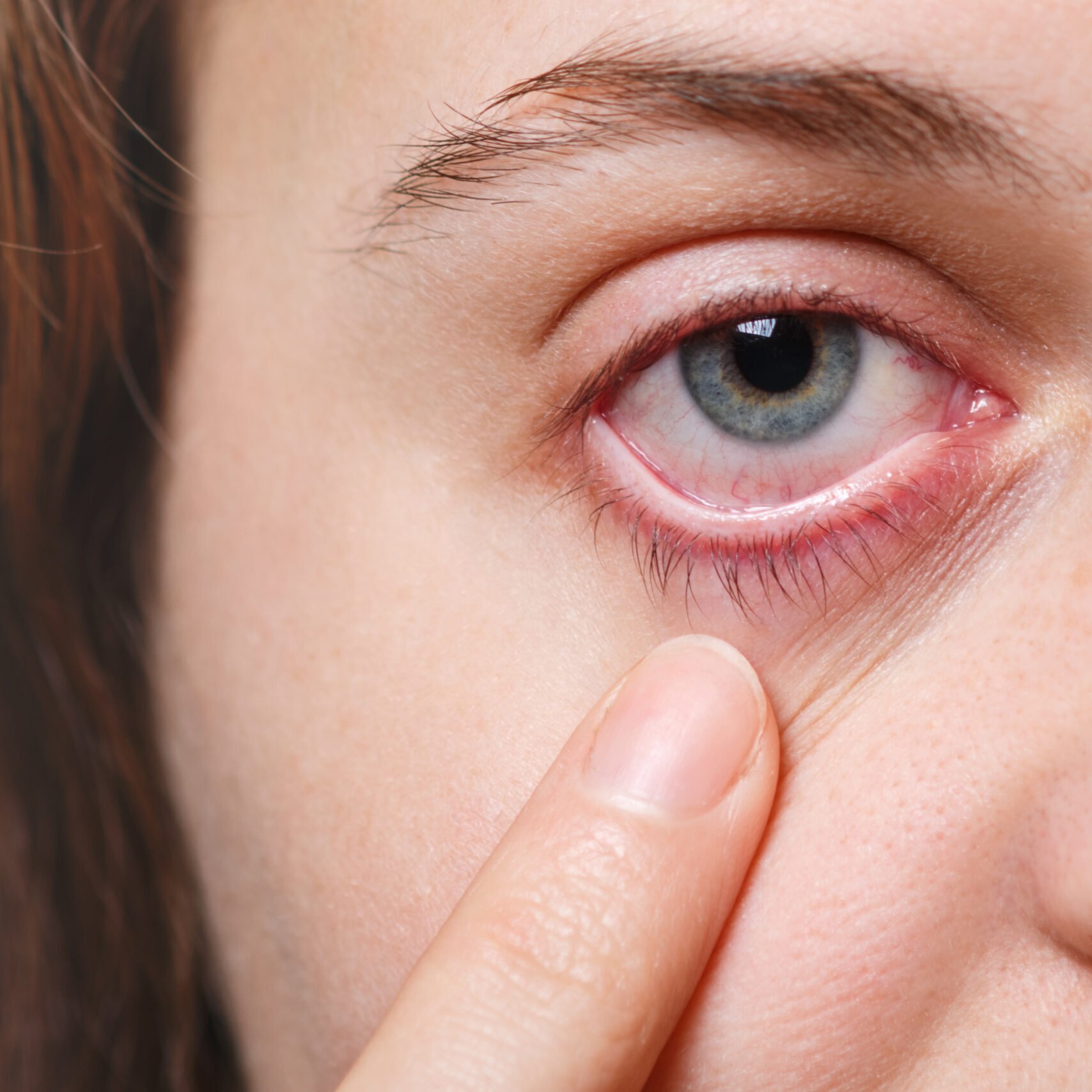 علاج التهاب ملتحمة العين